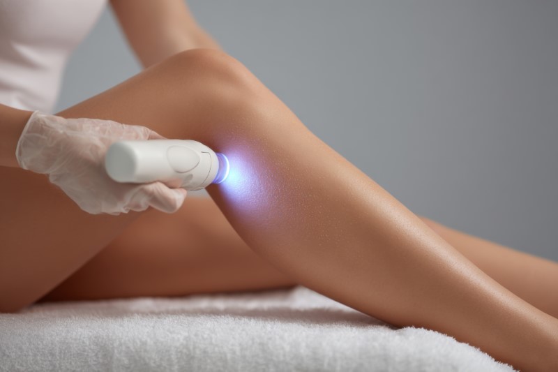 Laserowe usuwanie rozstępów – ostateczna metoda na gładką i jędrną skórę